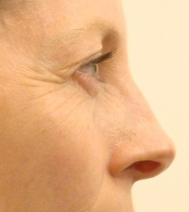 Crow-feet wrinkles.
