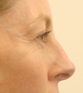 Crow-feet wrinkles after 2 weeks of daily applications of collagen-gel (pure collagen)
